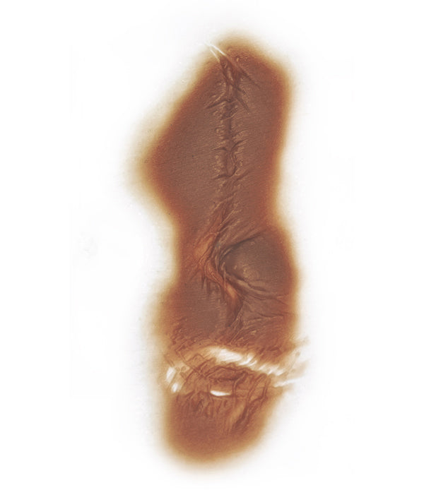 Large Body Scar