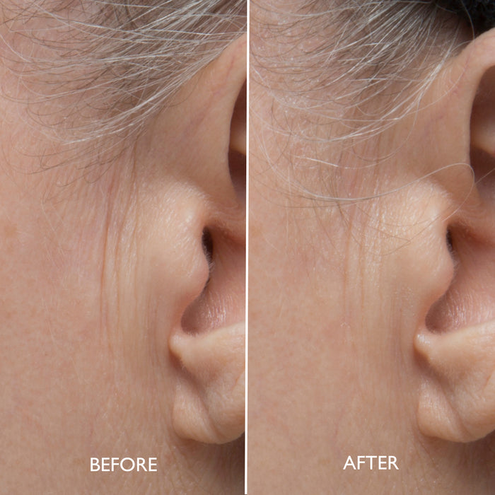 Age Benefit™ Refining Multi Acid Peel