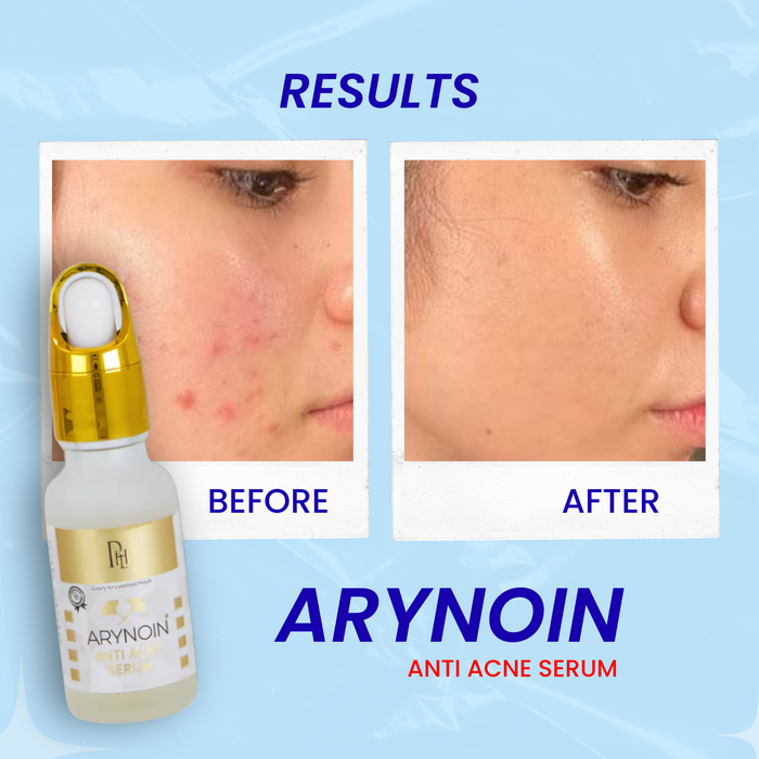 Arynoin (Anti Acne Serum)