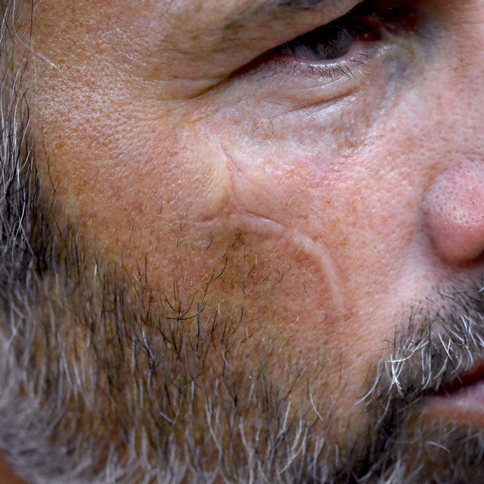 Chin Scar 3