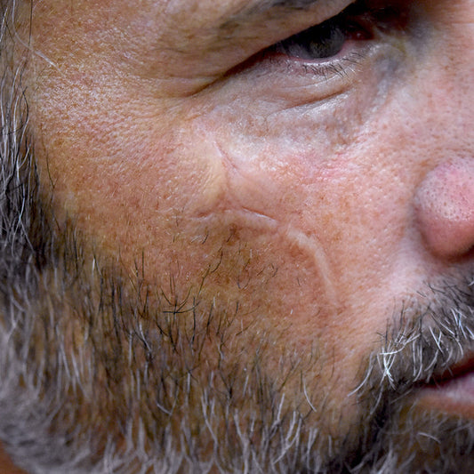 Chin Scar 3