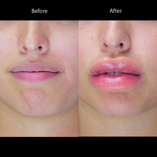 Swollen Lips