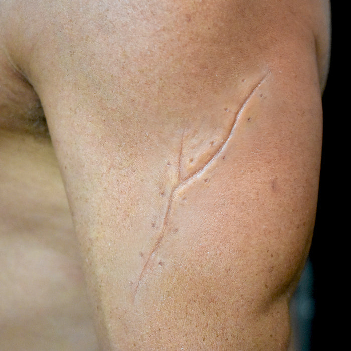 Y Scar 5